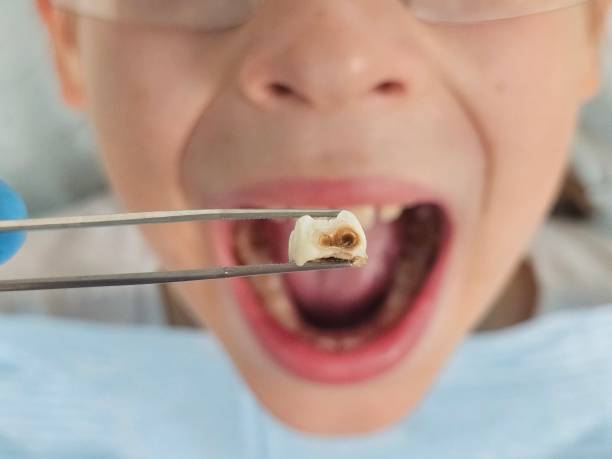 Best Emergency Tooth Extraction in Woody, WA
